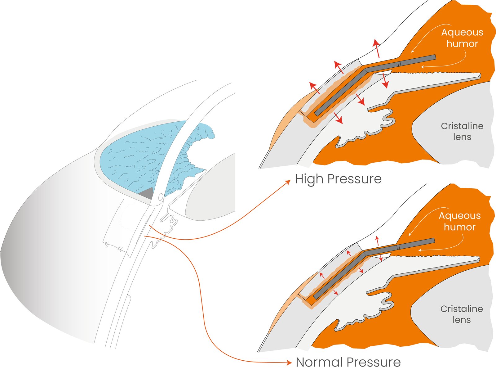 Diagram showing how the IPM implant works
