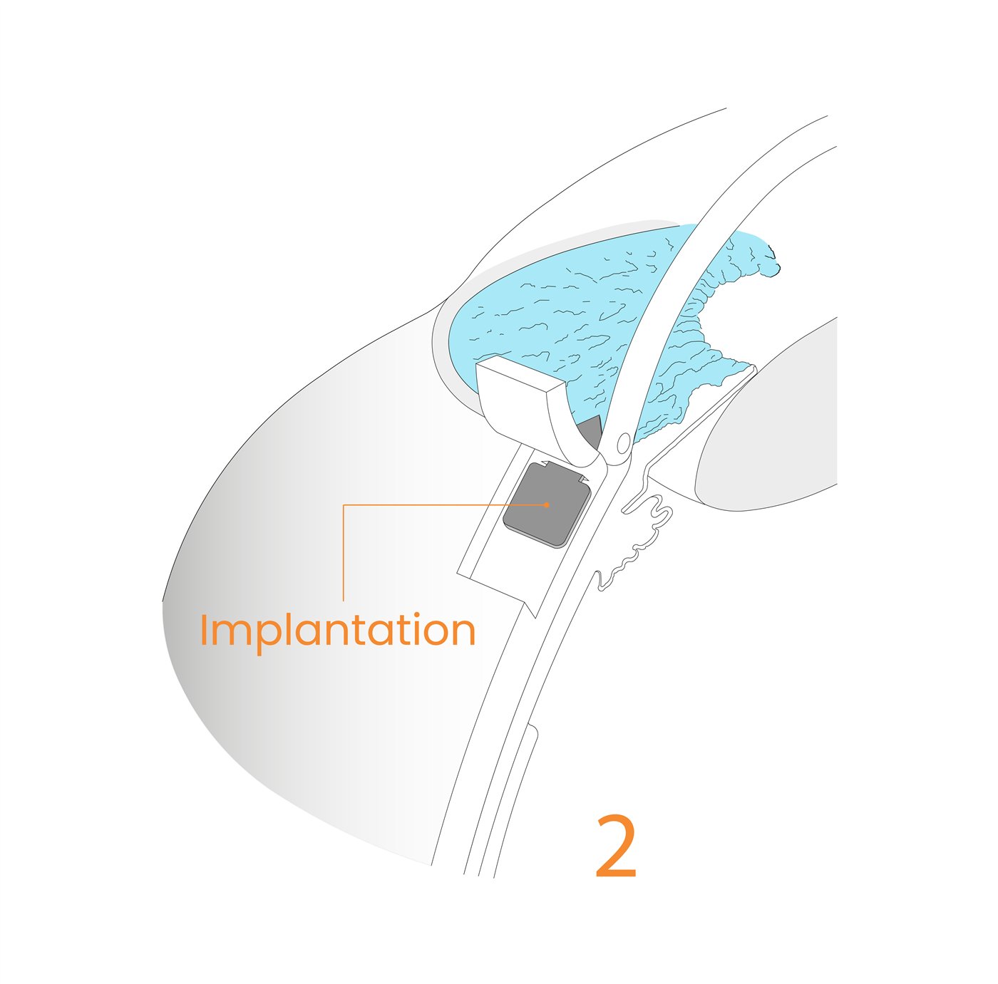 Implant procedure step 2