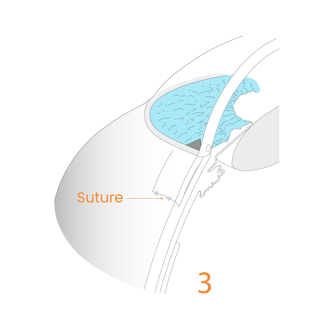 Implant procedure step 3
