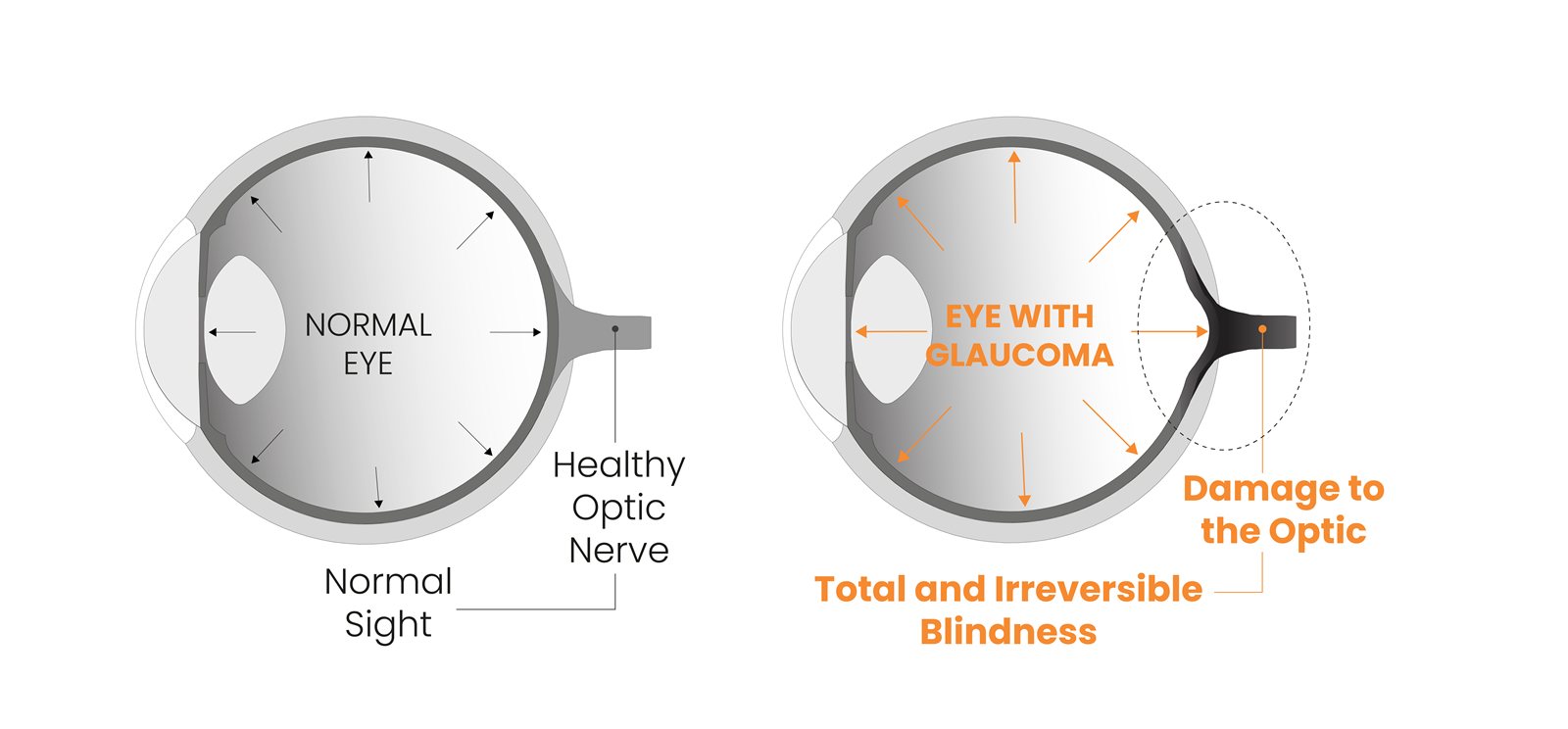 Illustration of glaucoma and the implant concept